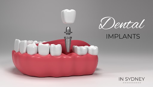 Dental Implant Costs: Single Tooth vs Full Mouth